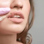 What to Expect from Lip Filler Treatments?